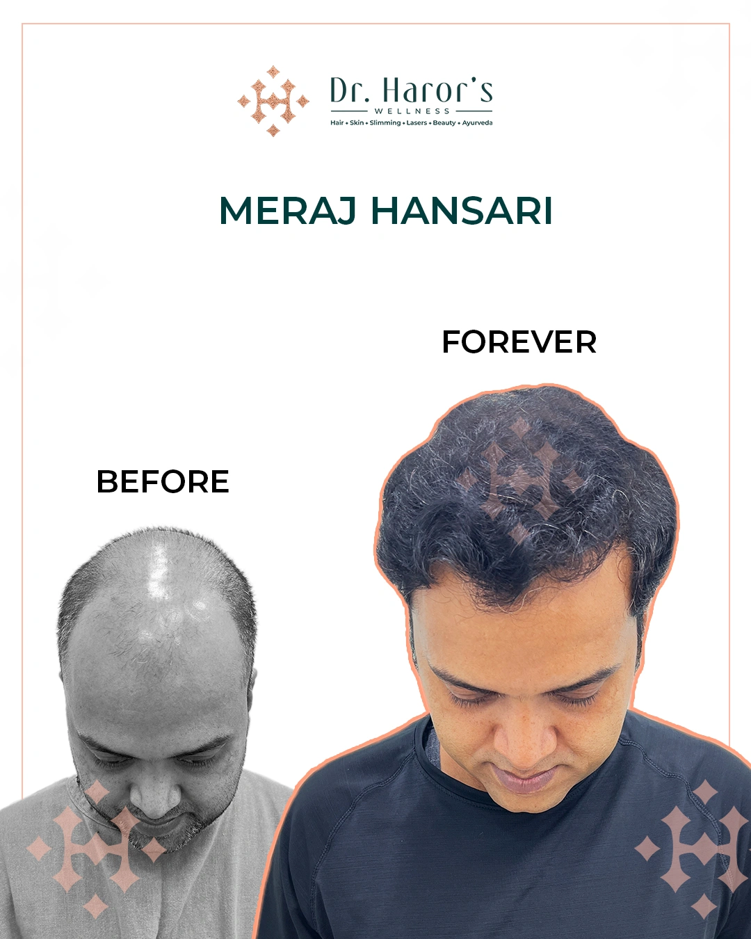 Hair Transplant Results in Delhi NCR India