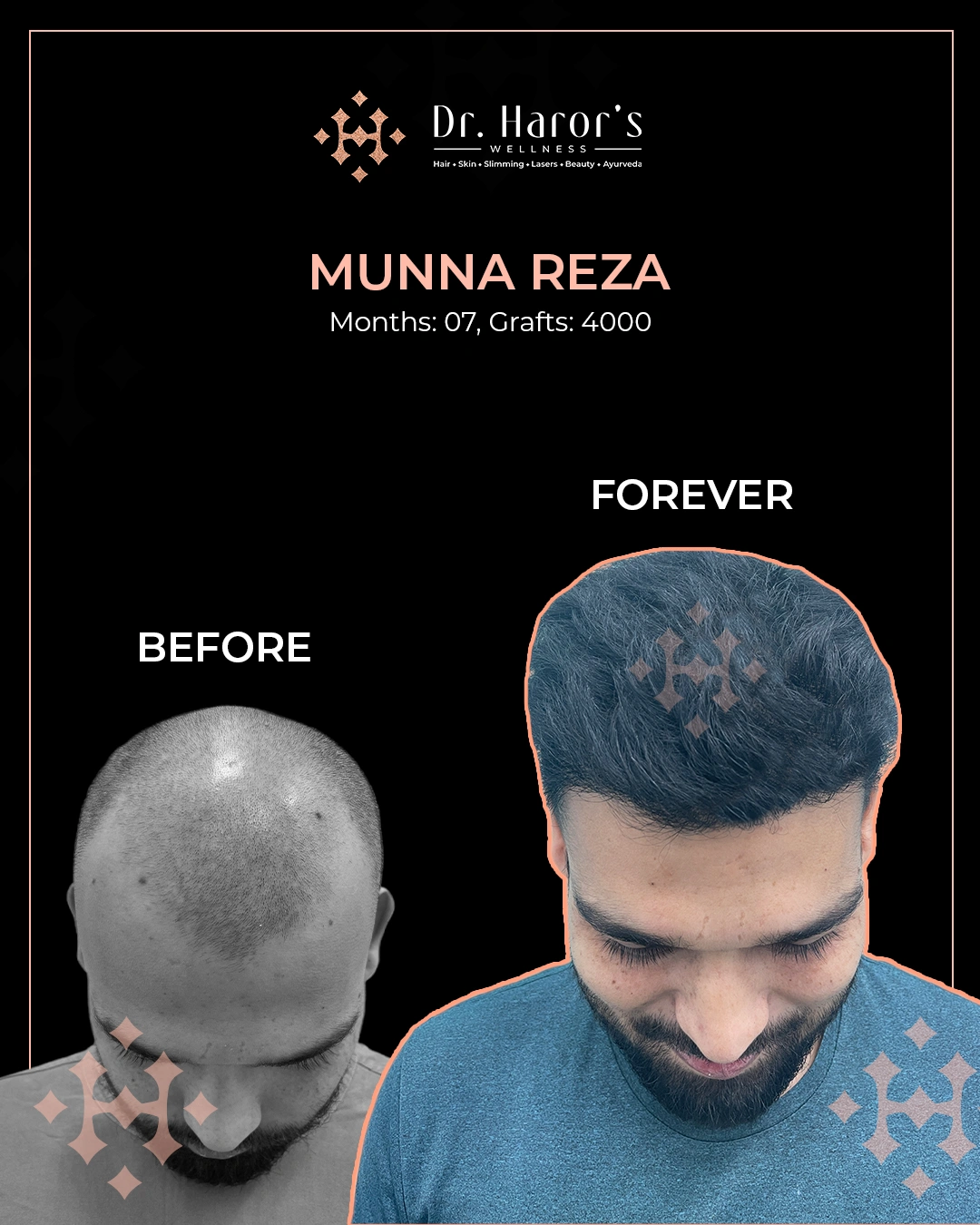 Hair Transplant Results in Delhi NCR India