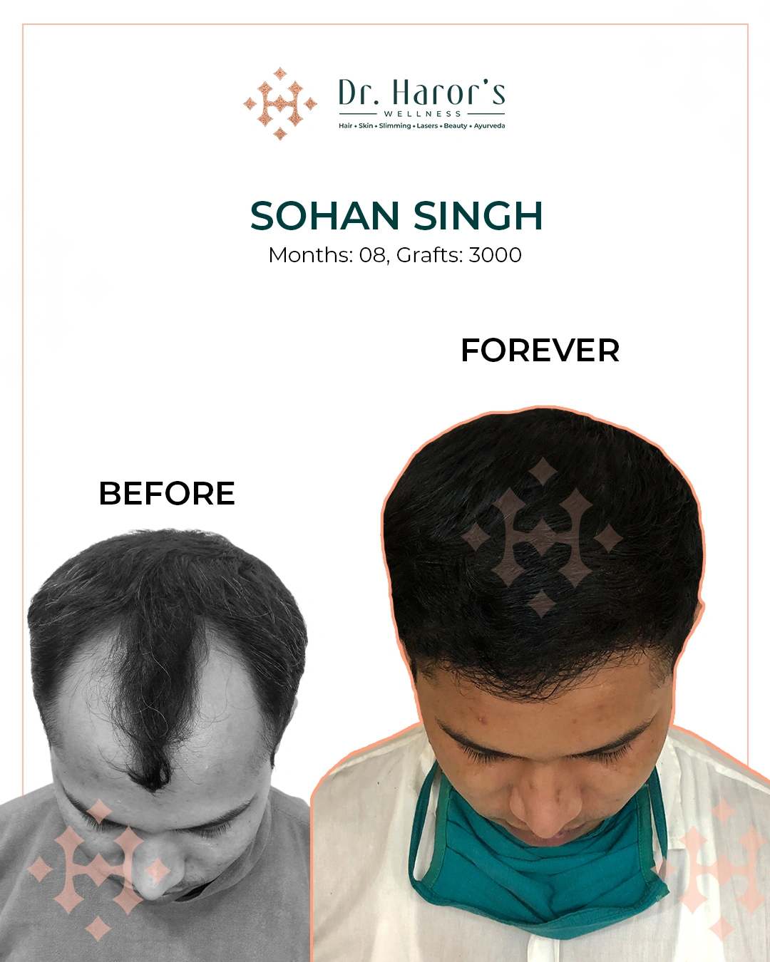 Hair Transplant Results in Delhi NCR India