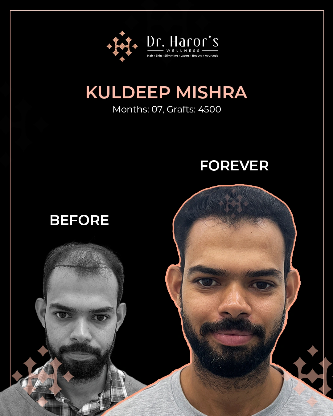 Hair Transplant Results in Delhi NCR India