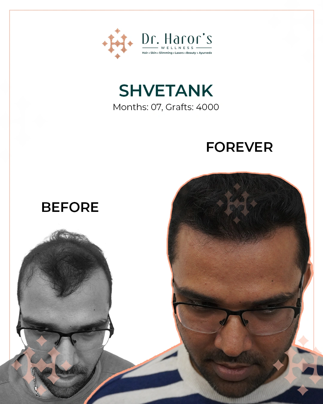 Hair Transplant Results in Delhi NCR India