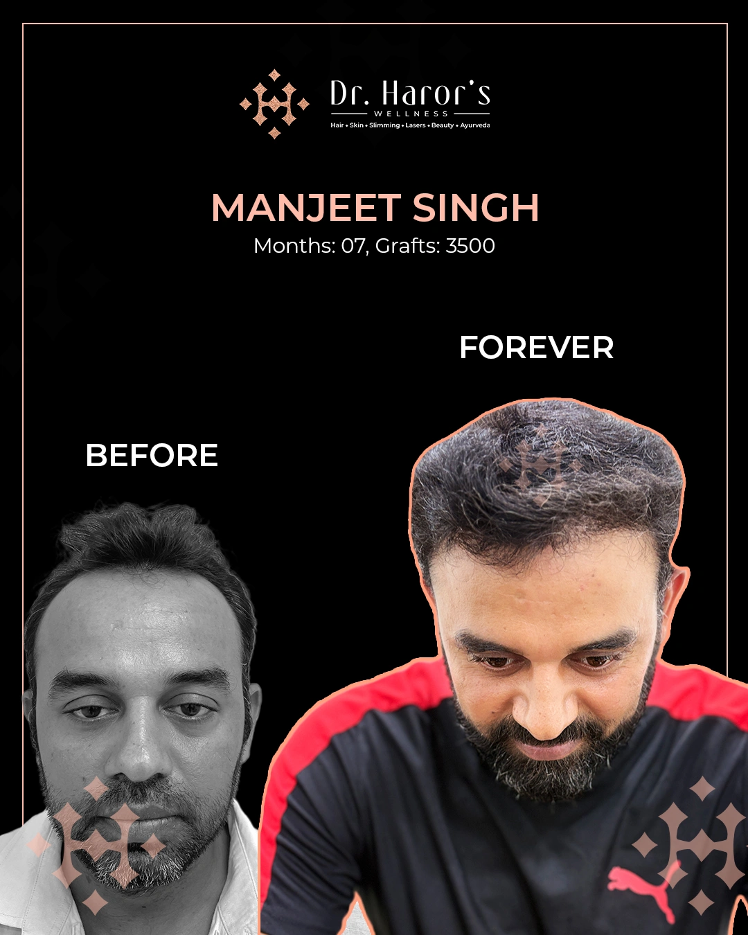 Hair Transplant Results in Delhi NCR India