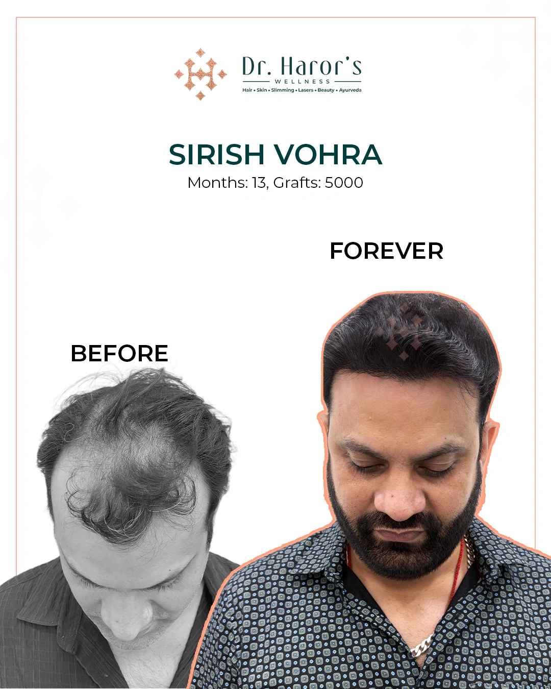 Hair Transplant Results in Delhi NCR India