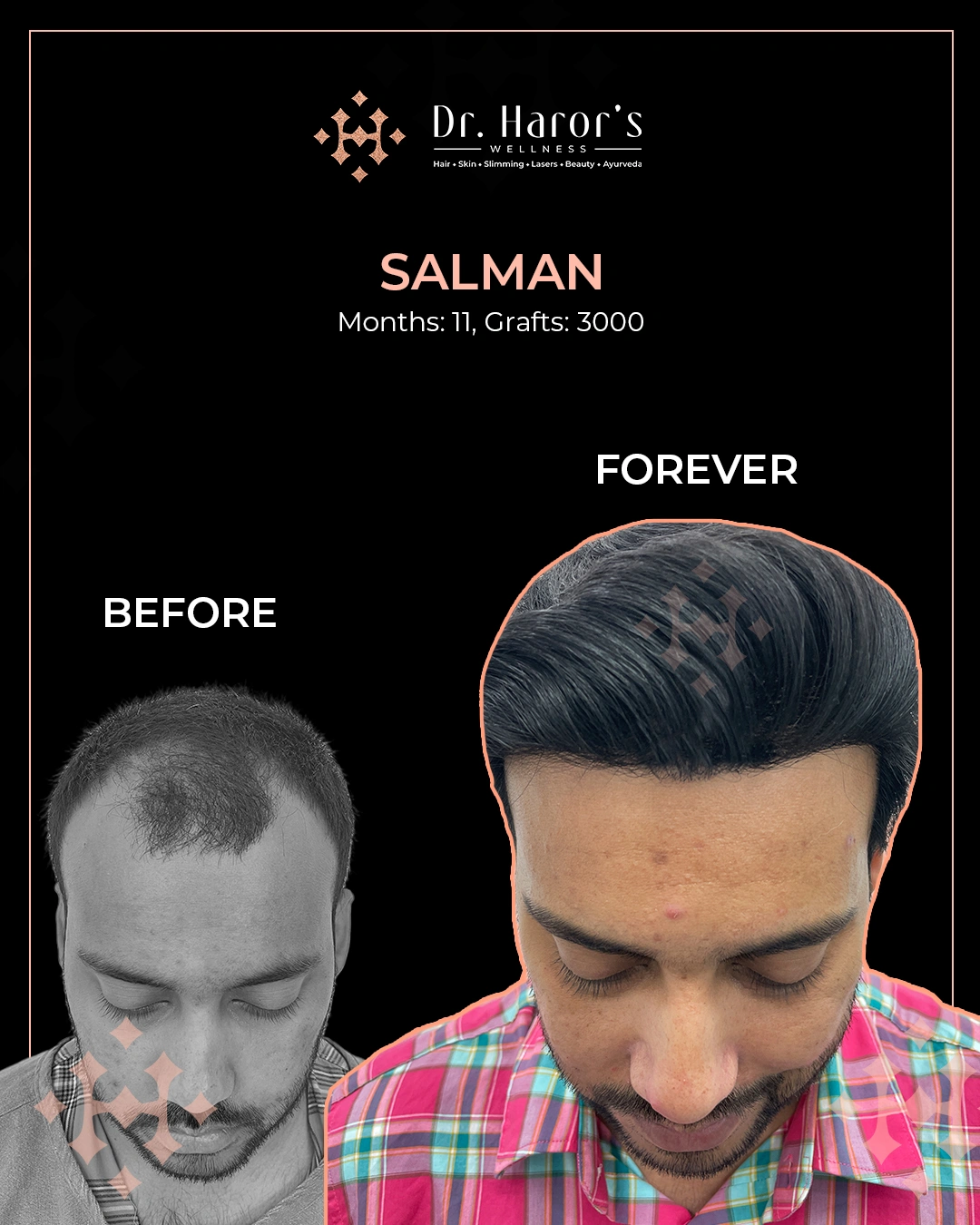 Hair Transplant Results in Delhi NCR India
