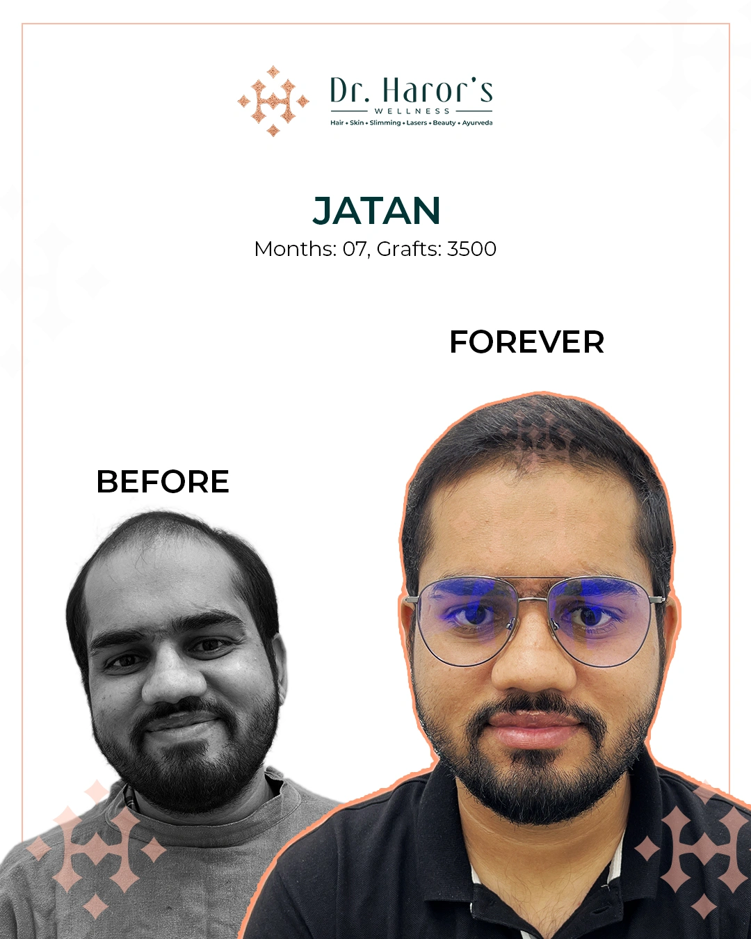 Hair Transplant Results in Delhi NCR India