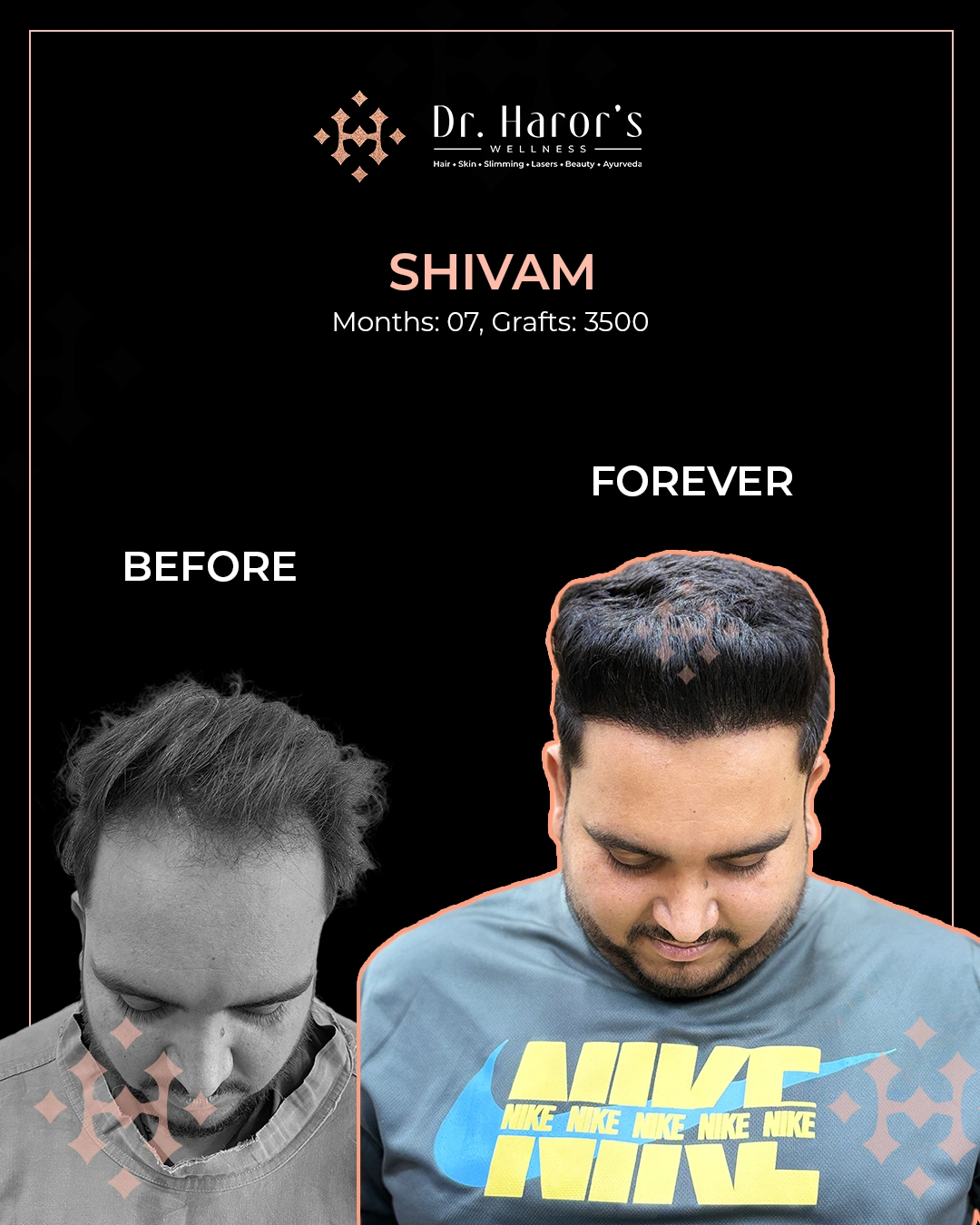 Hair Transplant Results in Delhi NCR India